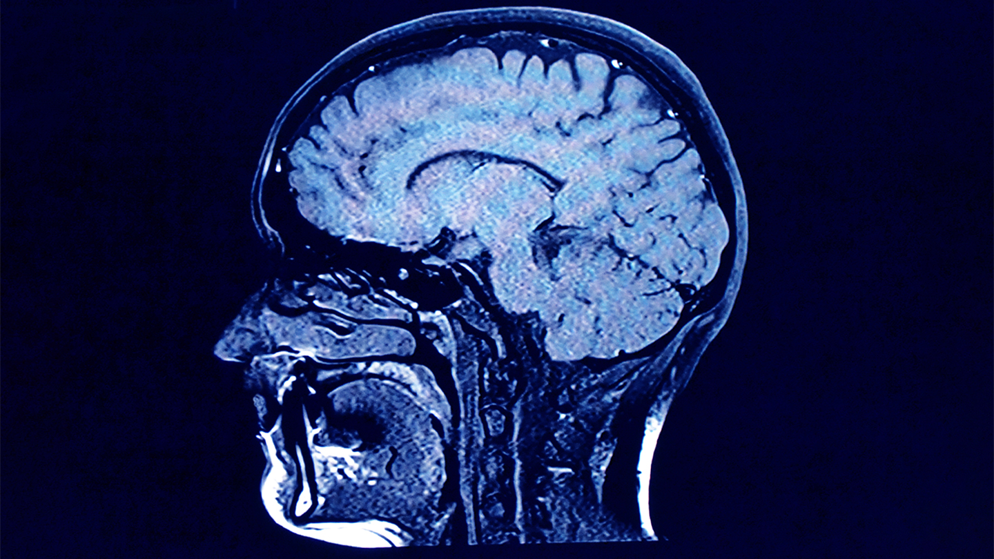 COVID-19 can affect the brain. New clues hint at how 1 COVID-19 can affect the brain. New clues hint at how