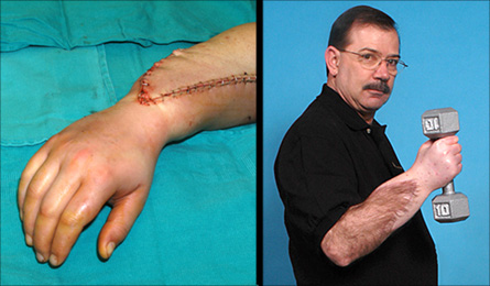 Four months after his December 2006 hand transplant, David Savage’s partial sense of touch in the new right hand activated the same brain area that would have controlled his original right hand 35 years earlier. The photo at left was taken shortly after the transplant, while the photo at right was taken one year after the procedure.