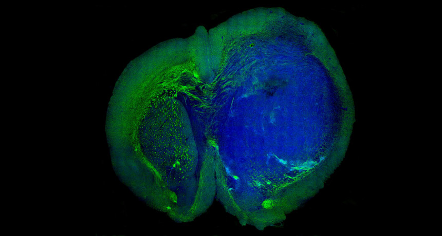 tumor tissue