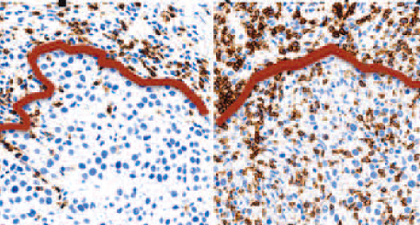 Melanoma tumor tissue and immune cells