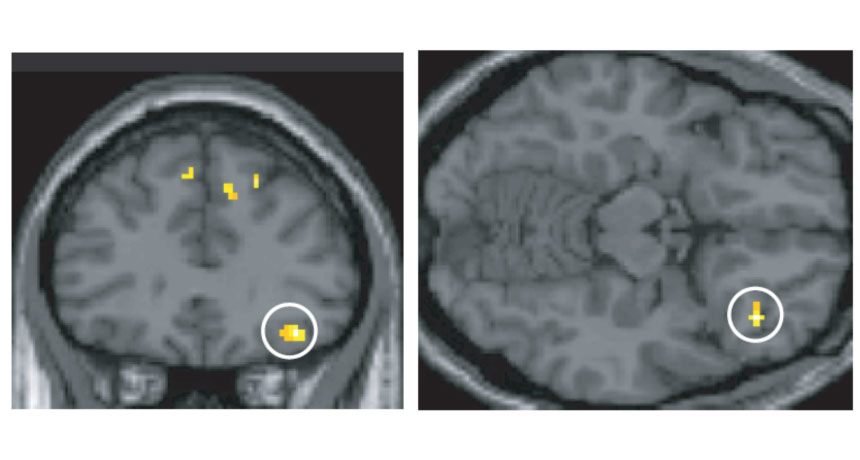 brain scans