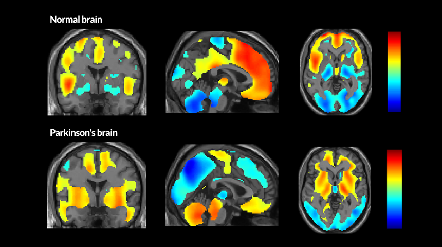 PET brain scans