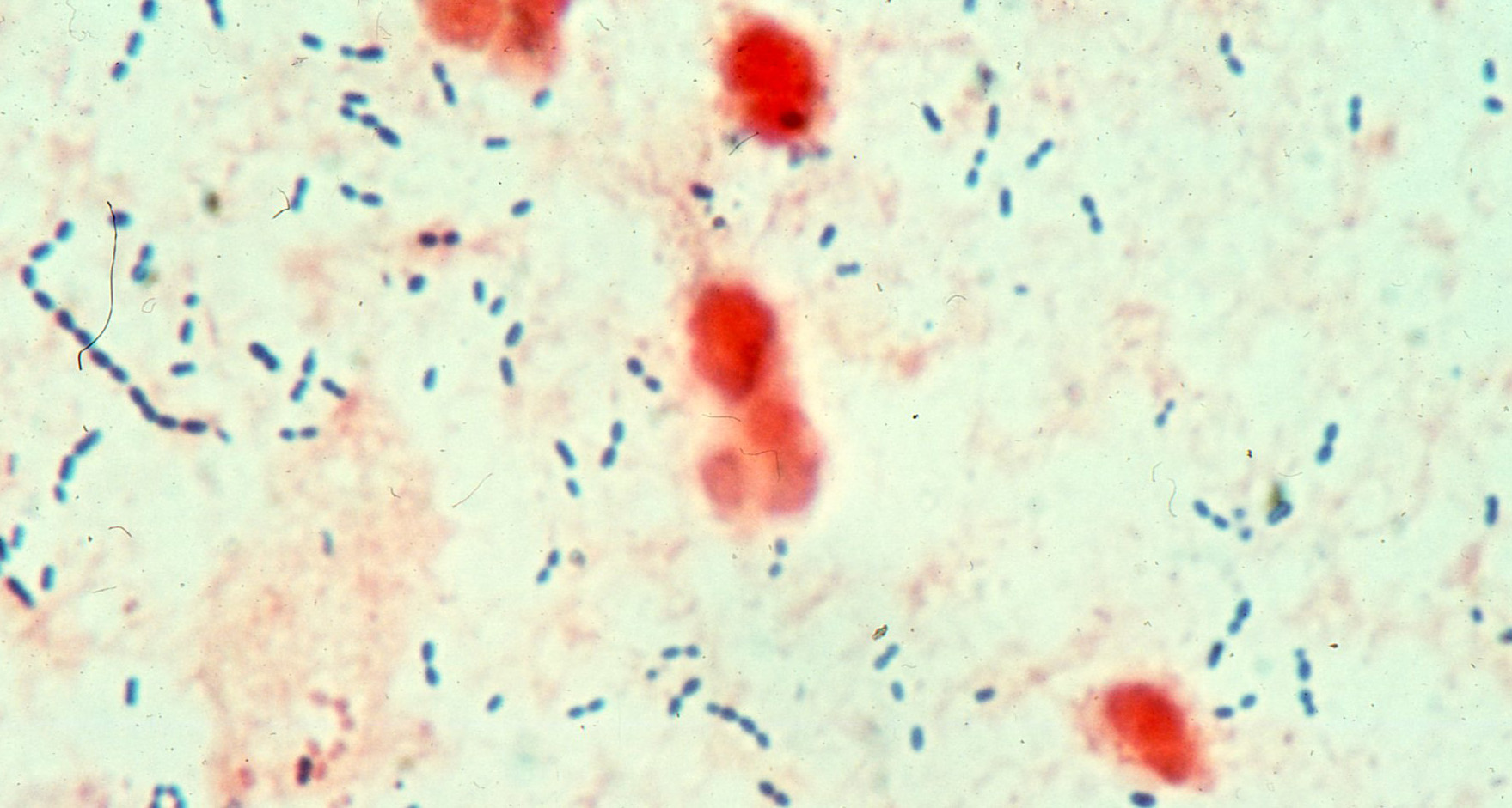 bacterial pneumonia cell