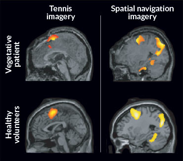 MRI scans