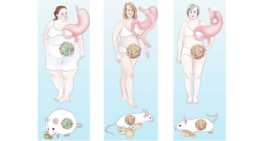 illustration of different weight loss surgeries