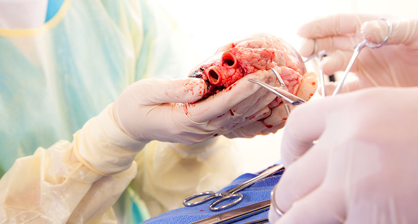 heart transplant