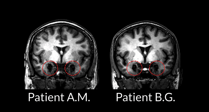 MRI scans