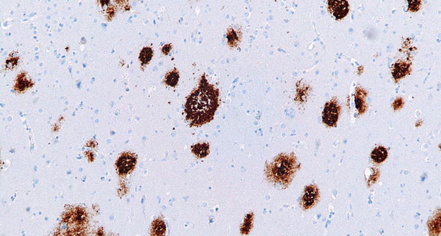 Alzheimer’s plaques in human brain