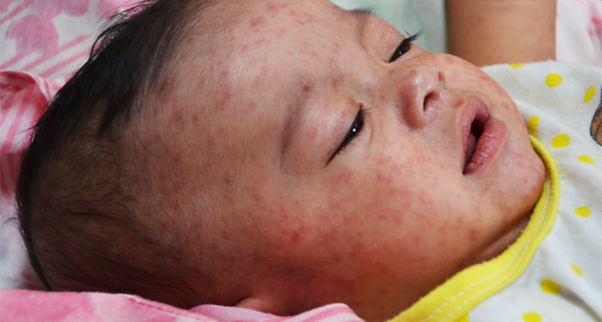 baby with measles