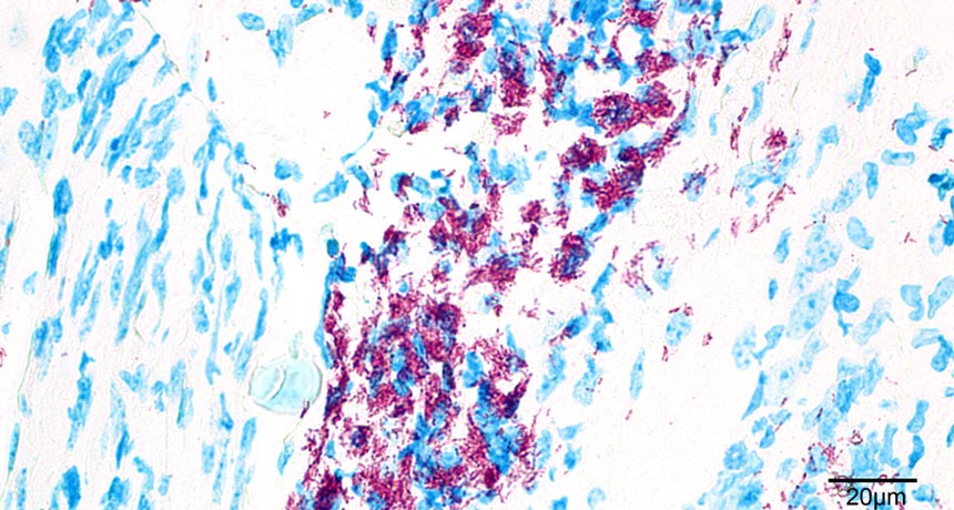 buruli ulcer