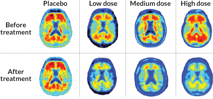 alzheimer's brain scans