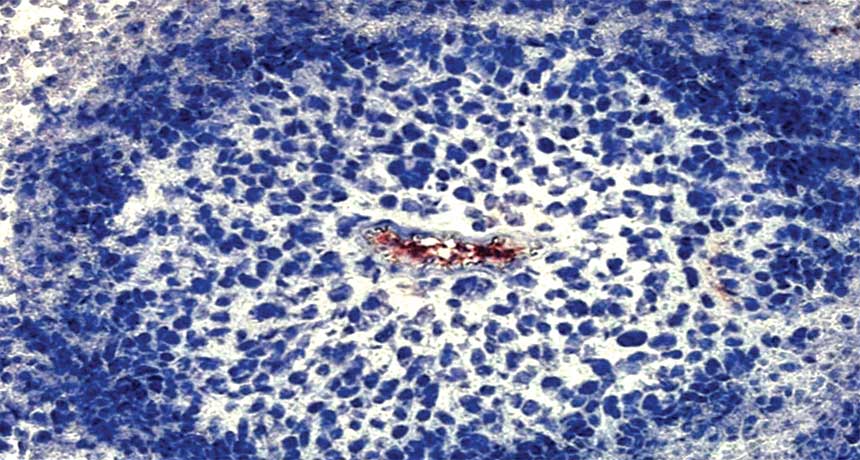 cancer cells