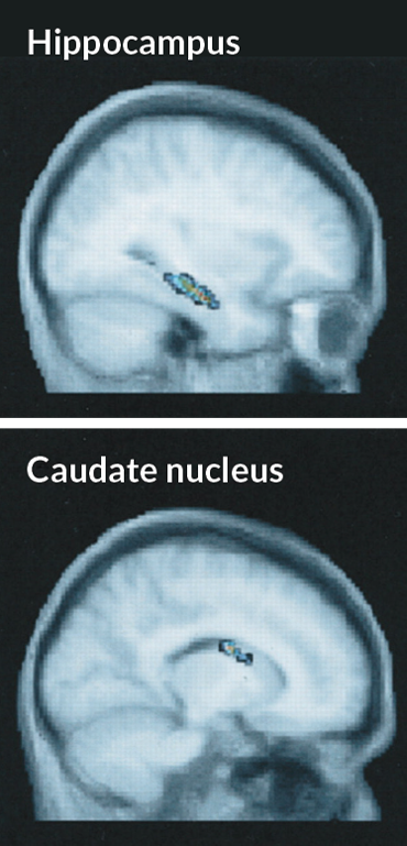 MRI scans of hippocampus and caudate nucleus