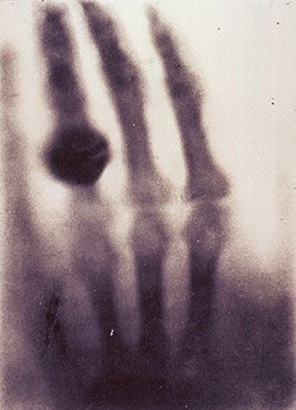 Roentgen's first x-ray of his wife's hand