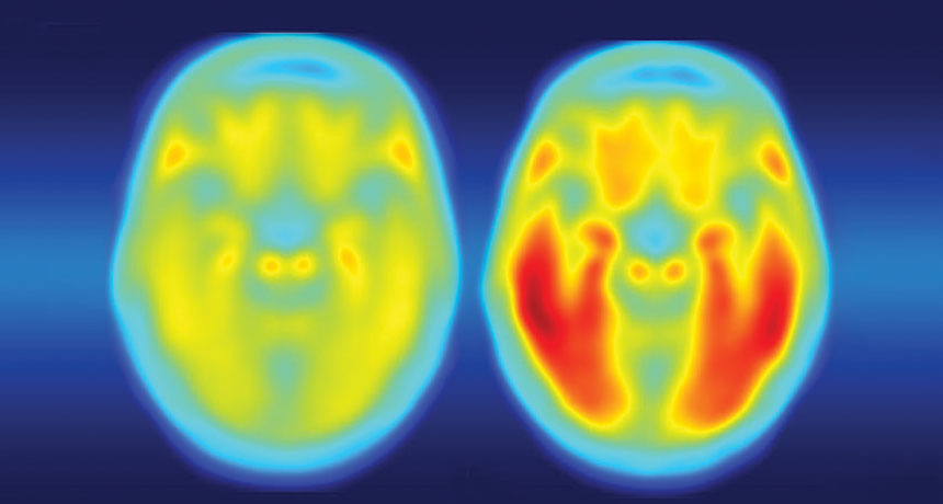 PET scans