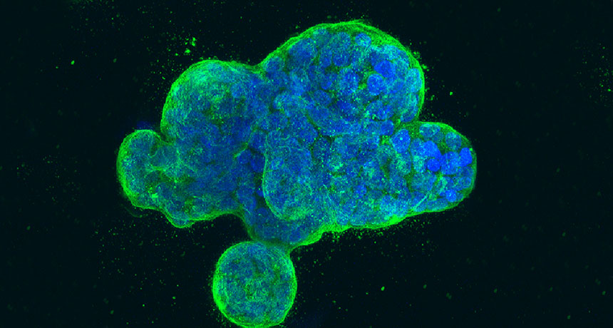 breast cancer cells