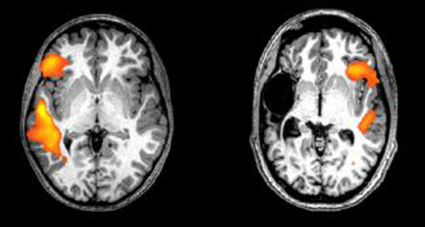 MRI scans of brains of healthy and stroke patients