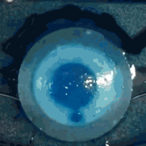 artificial eye