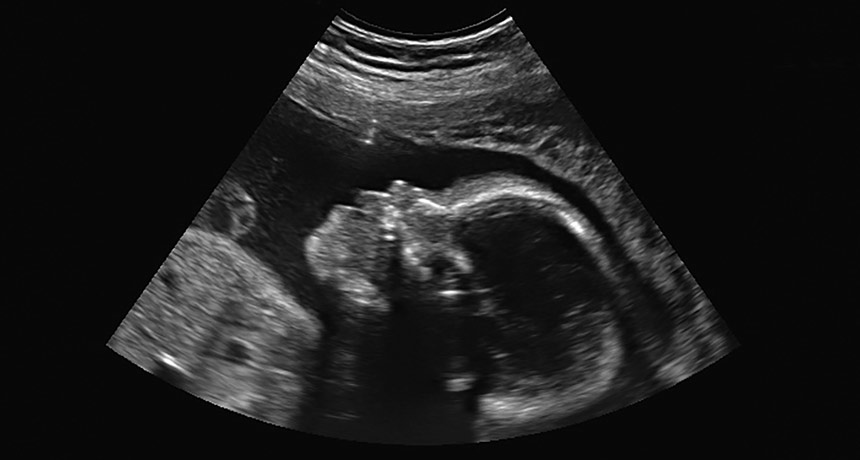 fetal ultrasound