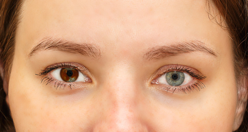 a photo of a face with two different eye colors