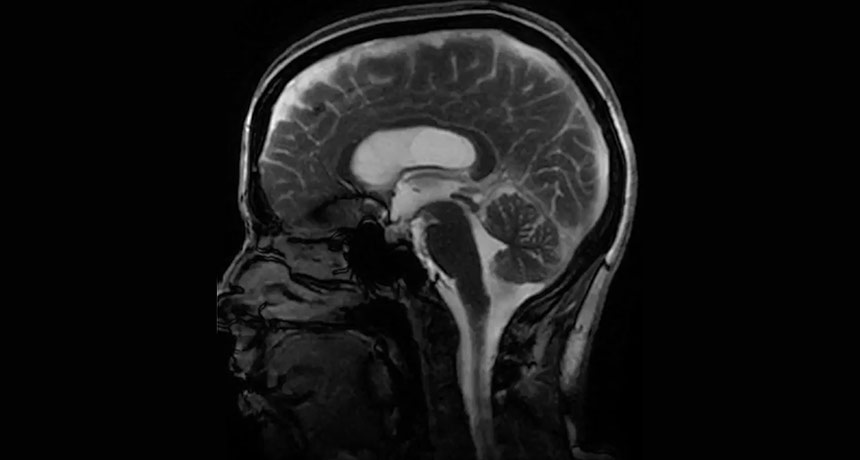 brain jiggling