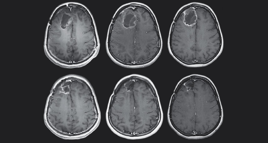 MRI images