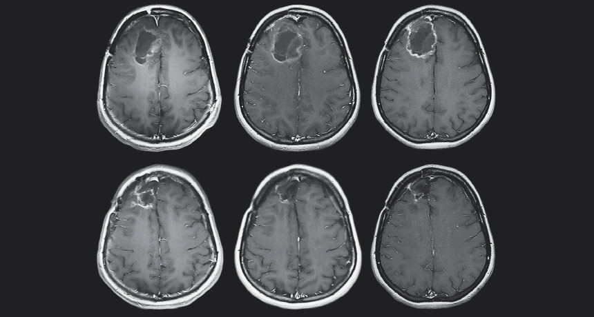 brain scan with tumor