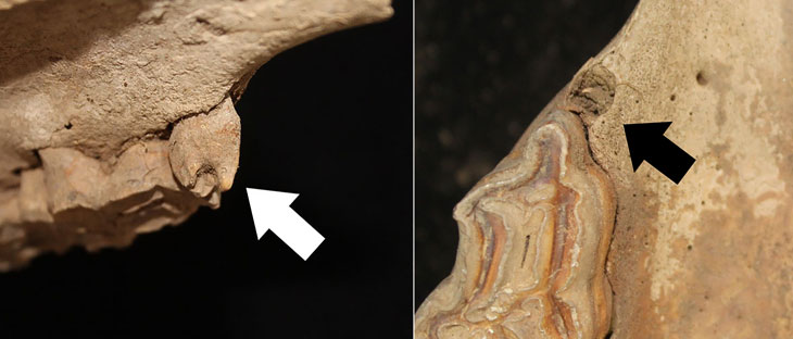 premolar extraction