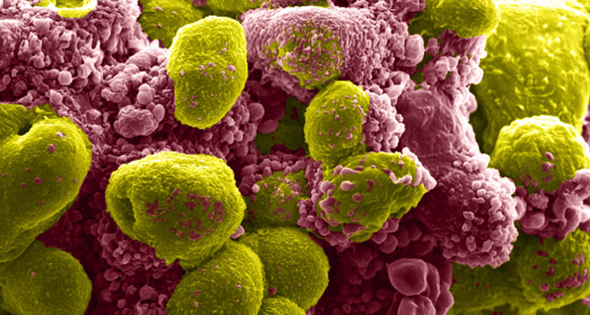 prostate tumor cells going through apoptosis