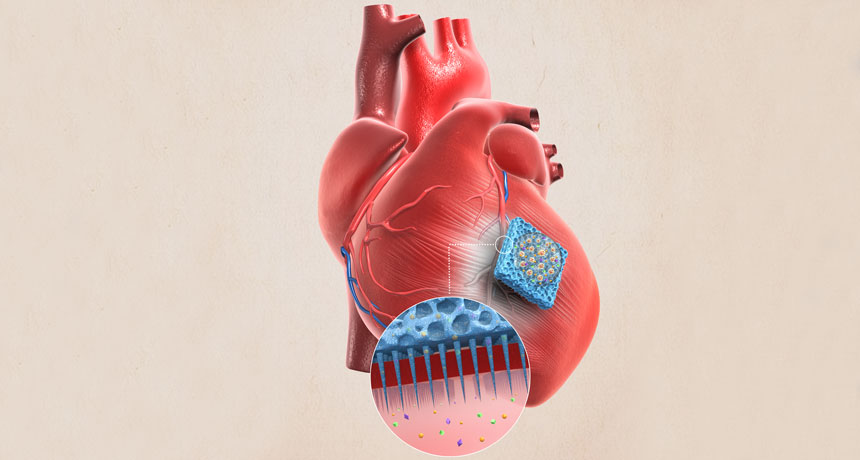 illustration of microneedle patch
