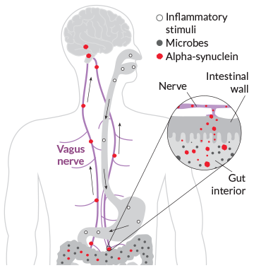 an illustration showing how an inflammatory reaction in the gut can cause nerve death in the brain