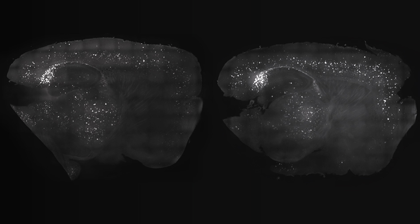 amyloid-beta plaques