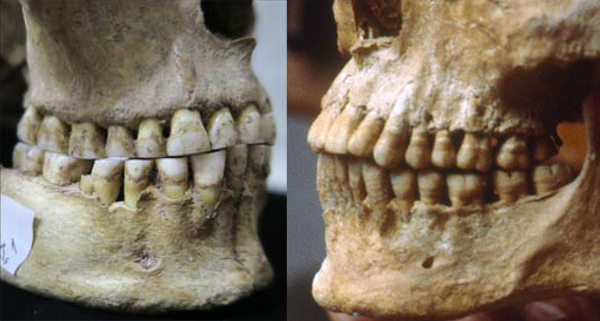 a composite photo of two skulls showing differences in overbites