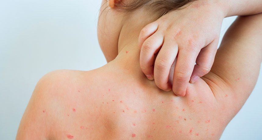 child scratching measles rash