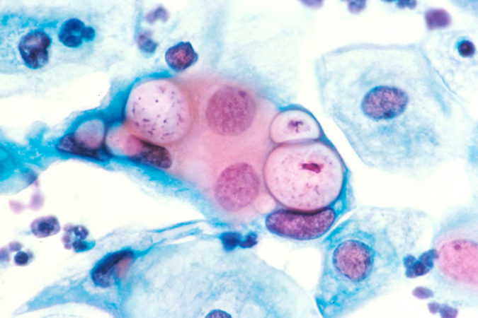 a Pap smear slide showing cells infected with Chlamydia trachomatis