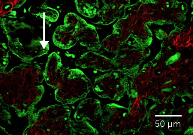 Black carbon particles in placenta tissue