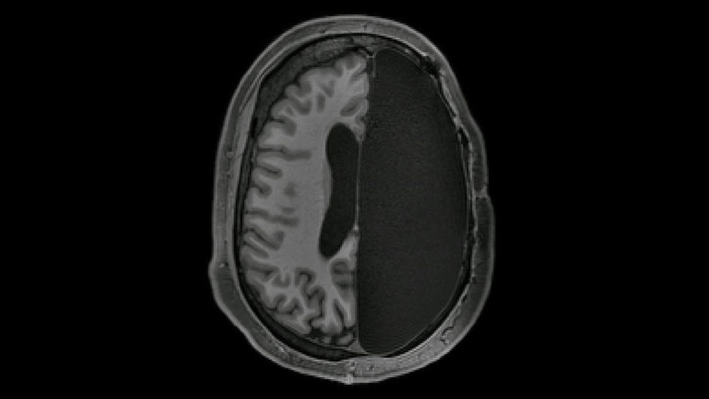 half of a brain