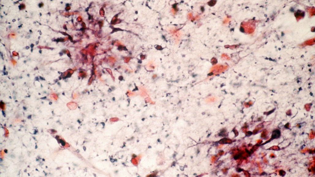 amyloid