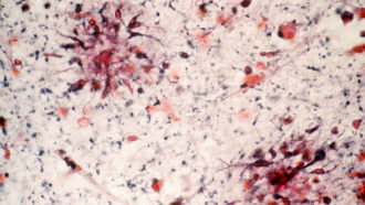 amyloid