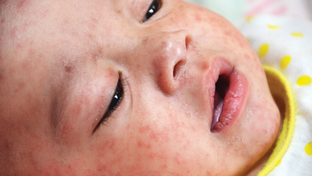 baby with measles rash
