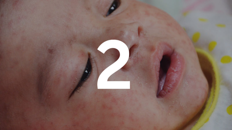 baby with measles