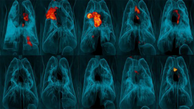 lung scans