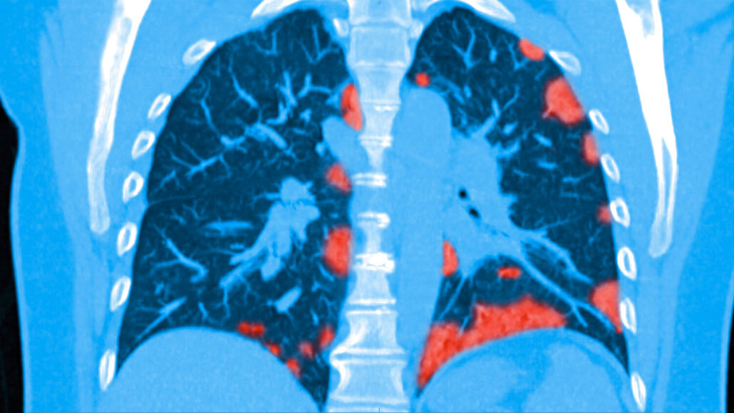 Some patients who survive COVID-19 may suffer lasting lung damage