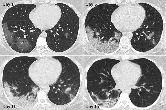 COVID-19 patient ct scans damage