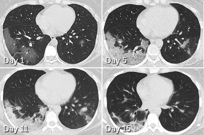 Some patients who survive COVID-19 may suffer lasting lung ...