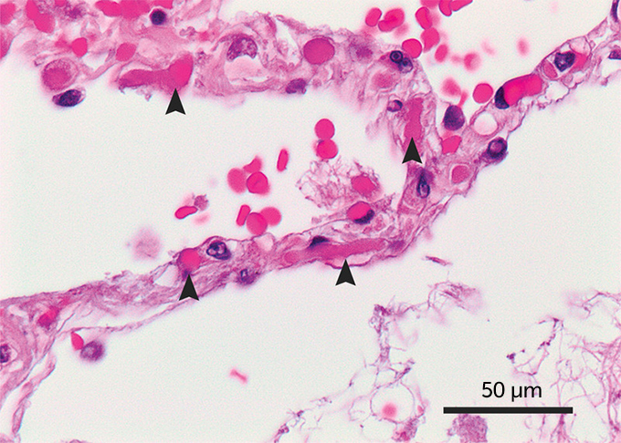 COVID-19 lung tissue sample