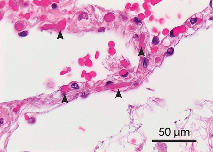 COVID-19 lung tissue sample