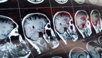 brain MRI images