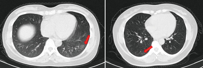 CT scan of SARS-CoV-2 patient's lungs