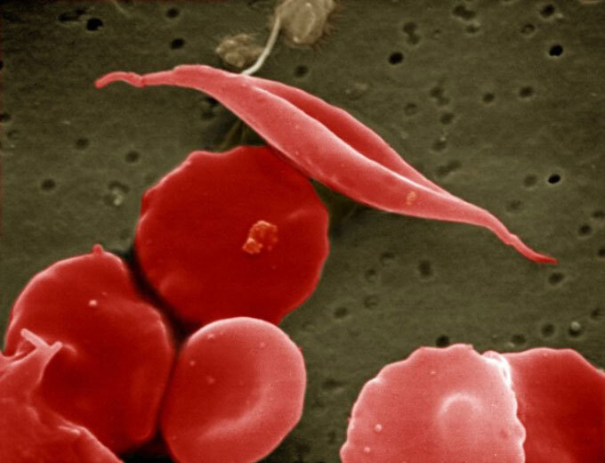 sickle red blood cell